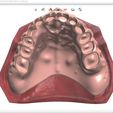 8.jpg Digital Full Dentures for Gluedin Teeth with Manual Reduction