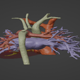 4.png 3D Model of Human Heart with Aortic Arch Hypoplasia (AAH) - generated from real patient