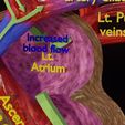 ps-0038.jpg PDA Patent Ductus Arteriosus vs Normal blood circulation