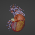 7.png 3D Model of Human Heart with Anomalous Pulmonary Venous Drainage (APVC) - generated from real patient