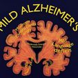 ps12.jpg Alzheimer Disease Brain coronal slice