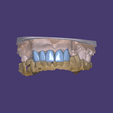 Posicionamiento.dentalCADscreenshot.png Telescopic crowns 0D 13, 12, 11, 21, 22