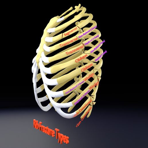 STL file Rib fracture and its types 🦴 ・Design to download and 3D print ...