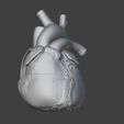3.jpg 有心房间隔缺损的心脏 3D 模型