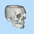 4.png Mandible implant-INDIVIDUAL PROSTHESIS FOR JAW RECONSTRUCTION