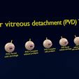 posterior-vitreous-detachment-types-eye-3d-model-blend-39.jpg Posterior vitreous detachment types eye 3D model