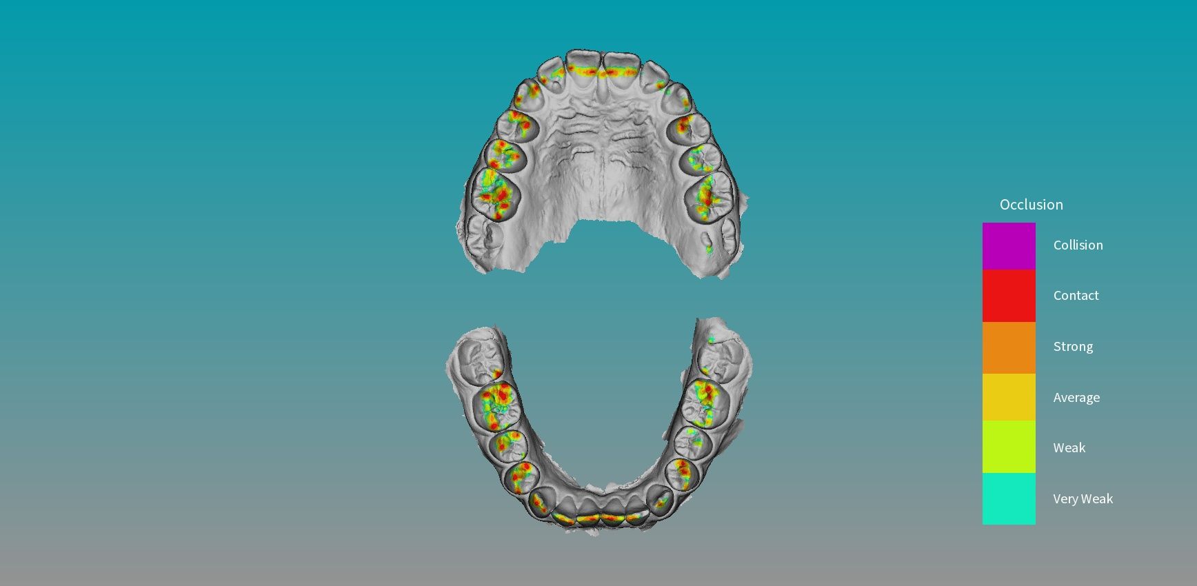 Occlusion Coco) Col) Contact Strong ONT i o-le AIAN stli4 Fichier STL LES DEUX MAXILLARS - SUPÉRIEUR et INFERIEUR scan intraoral (IOS) - AREA3D - Patient A. dentition complète・Design imprimable en 3D à télécharger, superdiente