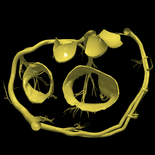 19.png 3D Model of Transposition of the Great Arteries Open Duct