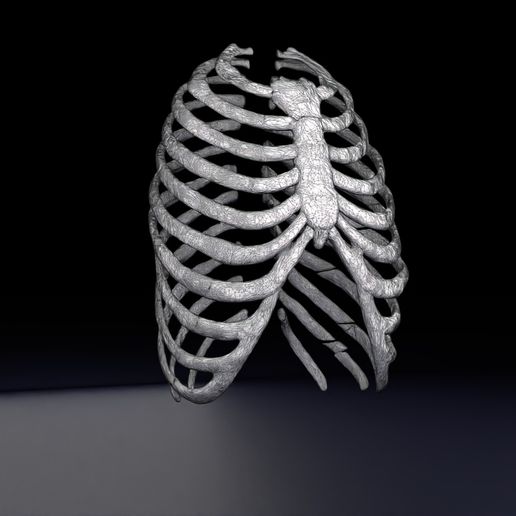 STL file Rib fracture and its types 🦴 ・Design to download and 3D print ...