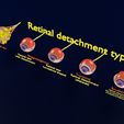 retinal-detachment-types-eye-3d-model-blend-67.jpg Retinal detachment types eye 3D model