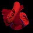 i3.jpg 3D Model of Heart with Atrial Septal Defect