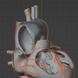 24.png 3D Model of Bicuspid Aortic Valve (BAV)