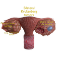 Untitled.png Krukenberg ovarian cancer tumor