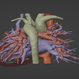 4.png 3D Model of Human Heart with Double Superior Vena Cava (DSVC) - generated from real patient
