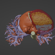 6.png 3D Model of Human Heart with Anomalous Pulmonary Venous Drainage (APVC) - generated from real patient