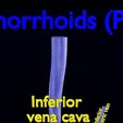 hemorrhoids-piles-3d-model-blend-74.jpg hemorrhoids piles 3D model