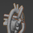 19.png 3D Model of Heart after Fontan Procedure