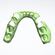 Clipboard-2024-05-06-10-51-16.jpg DIGITAL LOWER PARTIAL REMOVABLE DENTURE - flexible