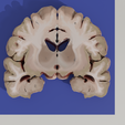 corte-coronal.png BRAIN FOR THE STUDY OF HUMAN ANATOMY, CORONAL AND TRANSVERSAL SECTIONS