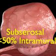 0015.jpg Fibroid Uterus Human female 3D