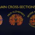 ps20.jpg Alzheimer Disease Brain coronal slice