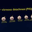 posterior-vitreous-detachment-types-eye-3d-model-blend-61.jpg Posterior vitreous detachment types eye 3D model