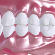11.png Digital Full Dentures with Combined Glue-in Teeth Arch