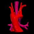 1.jpg 3D Model of Double Aortic Arch