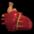 14.png 3D Model of Transposition of the Great Arteries Open Duct