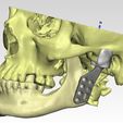 prosthetic-2.jpeg Individual TMJ prosthesis (real operation)