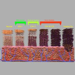1200a.jpg Cervical cancer dysplasia CIN 3D model