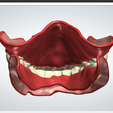 24.png Digital Full Dentures with Combined Glue-in Teeth Arch