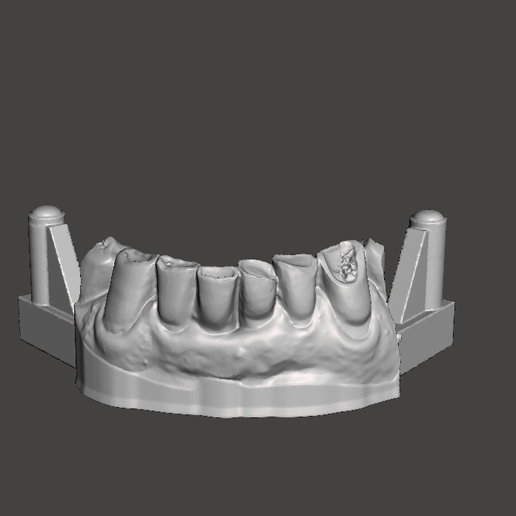 Educational Dental STL Model – Upper & Lower Jaw with Temporary Bridge 12–21