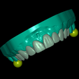 UpperJaw-veneer-n-articulator.png Dental Model With 10 Veneers and Articulator