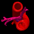 9.png 3D Model of Double Aortic Arch