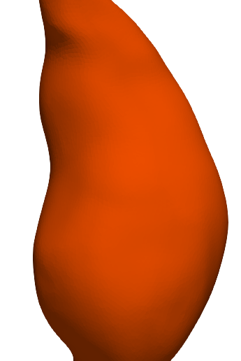3.png Model of an abdominal aortic aneurysm from a real patient