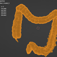 colon,-intestine,-mesenteric,-diverticulitis,-inflammation,-anatomy,-abdominal,-abdomen-6.png 3D Дивертикулит толстой кишки (обновлено)