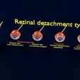 retinal-detachment-types-eye-3d-model-blend-86.jpg Retinal detachment types eye 3D model