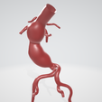 p2.png Case 1 to 6: 3D aortic and iliac artery aneurysm