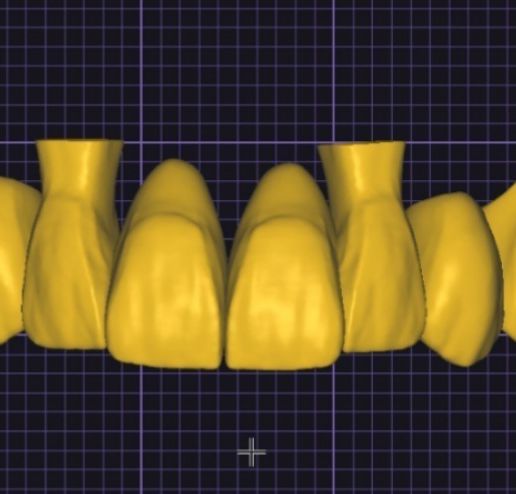 🦷 grin design exocad library teeth・ 3D File for 3D printing・Cults