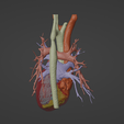 2.png 3D Model of Human Heart with Atrio-Ventricular Septal Defect (AVSD) - generated from real patient