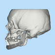 3.png Mandible implant-INDIVIDUAL PROSTHESIS FOR JAW RECONSTRUCTION