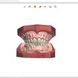 1.jpg Digital Full Dentures for Gluedin Teeth with Manual Reduction