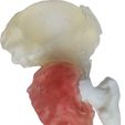 p2.jpg Sarcoma pélvico impresso em 3D e guia de corte 2
