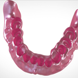 Screenshot_7.png Digital Full Dentures for Gluedin Teeth with Manual Reduction