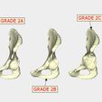 normal pelvis GRADE 2A GRADE 1 GRADE 2B GRADE 3A GRADE 3B Paprosky Classification of Acetabular Bone Loss