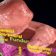 0017.jpg Fibroid Uterus Human female 3D