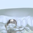 Snapshot_2017-8-29_15-51-31.jpg Digital Rapid Palatal Expander