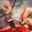 surgical-operation2.jpeg A cranial plate to replace a skull defect (an example of a real operation 2)