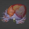 6.png 3D Model of Human Heart with Double Superior Vena Cava (DSVC) - generated from real patient